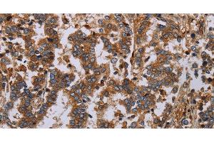 Immunohistochemistry of paraffin-embedded Human liver cancer using GDF2 Polyclonal Antibody at dilution of 1:40 (GDF2 Antikörper)