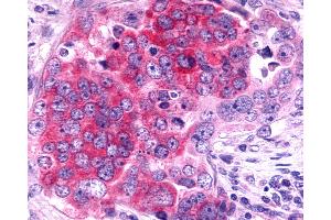 Anti-TAAR6 antibody IHC of human Ovary, Carcinoma. (TAAR6 Antikörper  (Cytoplasmic Domain))
