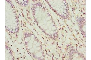 Immunohistochemistry of paraffin-embedded human colon cancer using ABIN7174542 at dilution of 1:100 (UBL3 Antikörper  (AA 17-114))