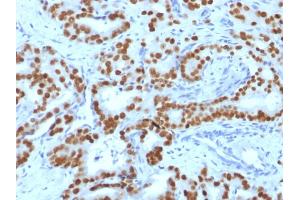Formalin-fixed, paraffin-embedded human Prostate Carcinoma stained with FOXA1 Monoclonal Antibody (FOXA1/1519).