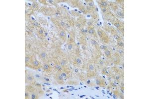 Immunohistochemistry of paraffin-embedded human liver cancer using Furin antibody (ABIN6127933, ABIN6140815, ABIN6140817 and ABIN6223322) at dilution of 1:100 (40x lens). (FURIN Antikörper  (AA 120-370))