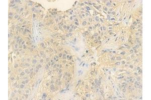 ABIN6260296 and ABIN6278210 at 1/100 staining human lung squamous cell carcinoma by IHC-P. (BNIP3 Antikörper  (C-Term))