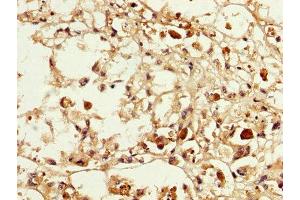 IHC image of ABIN7159260 diluted at 1:200 and staining in paraffin-embedded human melanoma performed on a Leica BondTM system. (MAGEA3 Antikörper  (AA 2-104))