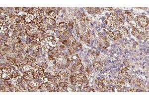 ABIN6279591 at 1/100 staining Human liver cancer tissue by IHC-P. (UNC5A Antikörper  (Internal Region))