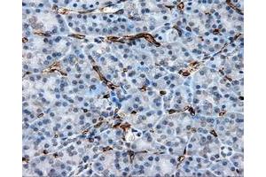 Immunohistochemical staining of paraffin-embedded Adenocarcinoma of ovary tissue using anti-CD36 mouse monoclonal antibody. (CD36 Antikörper)