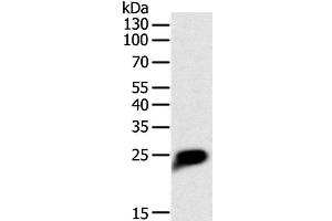 Western Blot analysis of Human liver cancer tissue using CRP Polyclonal Antibody at dilution of 1:1400 (CRP Antikörper)