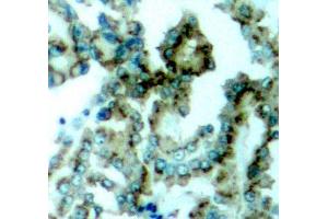Immunohistochemistry of paraffin-embedded human lung carcinoma tissue, using Phospho-PKCalpha/beta II-T638/641 antibody (ABIN2987563). (PKC beta Antikörper  (pThr641))