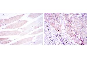 Immunohistochemical analysis of paraffin-embedded muscle tissues (left) and kidney cancer tissues (right) using BMPR2 mouse mAb with DAB staining. (BMPR2 Antikörper)