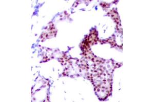 Immunohistochemical analysis of paraffin-embedded human breast carcinoma tissue using Phospho-RELA-S276 antibody. (NF-kB p65 Antikörper  (pSer276))