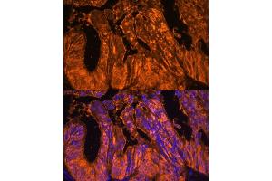 Immunofluorescence analysis of human colon carcinoma using Galectin 4/LG Polyclonal Antibody (ABIN7267339) at dilution of 1:100 (40x lens). (GAL4 Antikörper  (AA 1-100))