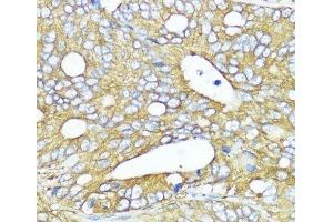 Immunohistochemistry of paraffin-embedded Human colon carcinoma using MLKL Polyclonal Antibody at dilution of 1:200 (40x lens). (MLKL Antikörper)