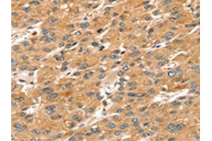 The image on the left is immunohistochemistry of paraffin-embedded Human liver cancer tissue using ABIN7192624(SPATA18 Antibody) at dilution 1/20, on the right is treated with synthetic peptide. (SPATA18 Antikörper)