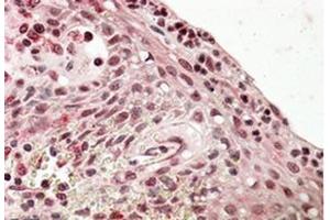 Immunohistochemistry (Paraffin-embedded Sections) (IHC (p)) image for anti-PR Domain Containing 1, with ZNF Domain (PRDM1) (Internal Region) antibody (ABIN615923) (PRDM1 Antikörper  (Internal Region))