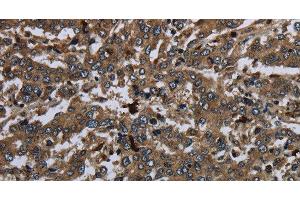 Immunohistochemistry of paraffin-embedded Human liver cancer using CD42b Polyclonal Antibody at dilution of 1:60 (CD42b Antikörper)