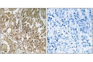 Immunohistochemistry analysis of paraffin-embedded human breast carcinoma tissue, using BUB1 Antibody.