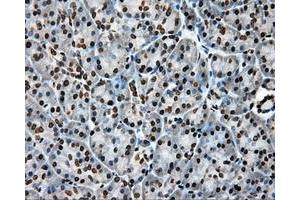Immunohistochemical staining of paraffin-embedded Adenocarcinoma of colon tissue using anti-APP mouse monoclonal antibody. (APP Antikörper)