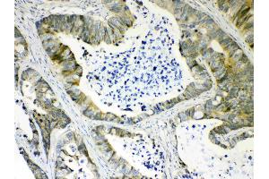 IHC analysis of AKR1B10 using anti- AKR1B10 antibody . (AKR1B10 Antikörper  (C-Term))