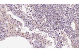 ABIN6273159 at 1/100 staining Human lymph cancer tissue by IHC-P. (SEC24A Antikörper  (Internal Region))