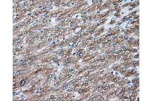 Immunohistochemical staining of paraffin-embedded Carcinoma of liver tissue using anti-NIT2 mouse monoclonal antibody. (NIT2 Antikörper)