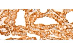 Immunohistochemistry of paraffin-embedded Human thyroid cancer tissue using ZMYND10 Polyclonal Antibody at dilution of 1:35(x200) (ZMYND10 Antikörper)