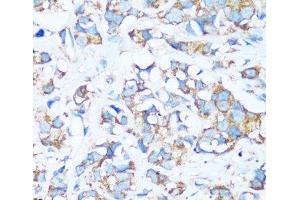 Immunohistochemistry of paraffin-embedded Human breast cancer using ARHGEF5 Polyclonal Antibody at dilution of 1:100 (40x lens). (ARHGEF5 Antikörper)