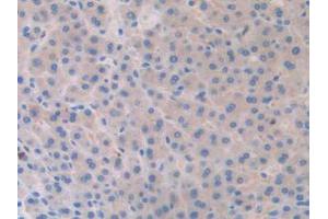 IHC-P analysis of Human Liver Cancer Tissue, with DAB staining. (SLIT1 Antikörper  (AA 647-835))