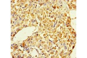 Immunohistochemistry of paraffin-embedded human melanoma using ABIN7145605 at dilution of 1:100 (MUTED Antikörper  (AA 2-187))