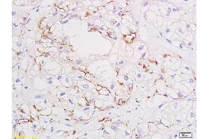 Formalin-fixed and paraffin embedded human colon carcinoma tissue labeled with Anti VEGF Polyclonal Antibody,Unconjugated (ABIN674829) at 1:200 followed by conjugation to the secondary antibody and DAB staining. (VEGF Antikörper)