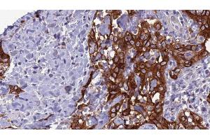 ABIN6266638 at 1/100 staining Human Head and neck cancer tissue by IHC-P. (Synaptophysin Antikörper  (Internal Region))