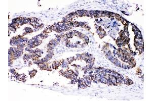 IHC analysis of Cytokeratin 8 using anti-Cytokeratin 8 antibody (ABIN5518853). (KRT8 Antikörper  (AA 107-325))