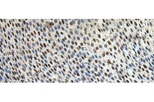 Immunohistochemistry of paraffin-embedded Human lung cancer tissue using DDX39A Polyclonal Antibody at dilution of 1:65(x200) (DDX39 Antikörper)