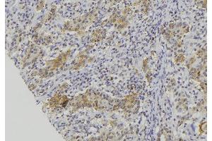 ABIN6273134 at 1/100 staining Human lung cancer tissue by IHC-P. (CMA1 Antikörper  (C-Term))