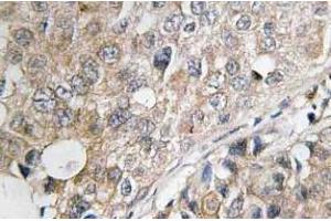 Immunohistochemistry (IHC) analyzes of MKP-1/2 antibody in paraffin-embedded human breast carcinoma tissue. (DUSP1 Antikörper)