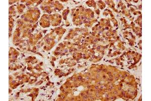 IHC image of ABIN7157587 diluted at 1:400 and staining in paraffin-embedded human pancreatic cancer performed on a Leica BondTM system. (KIF13A Antikörper  (AA 1383-1537))