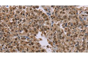 Immunohistochemistry of paraffin-embedded Human liver cancer tissue using MRGPRX1 Polyclonal Antibody at dilution 1:40 (MRGPRX1 Antikörper)