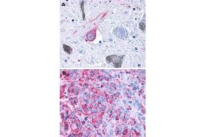 Immunohistochemical (Formalin/PFA-fixed paraffin-embedded sections) staining in human brain, substantia nigra (A) and human melanoma (B) with GPR50 polyclonal antibody . (GPR50 Antikörper  (C-Term))