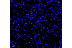 Immunofluorescence of paraffin embedded human liver cancer using RBM8A (ABIN7075478) at dilution of 1: 300 (400x lens) (RBM8A Antikörper)