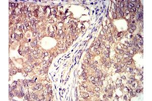 Immunohistochemical analysis of paraffin-embedded cervical cancer tissues using BTN2A2 mouse mAb with DAB staining. (BTN2A2 Antikörper  (AA 57-237))