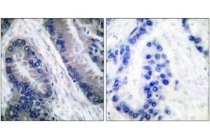 Immunohistochemistry analysis of paraffin-embedded human lung carcinoma, using IL-1 beta (Cleaved-Asp210) Antibody. (IL-1 beta Antikörper  (Cleaved-Asp210))