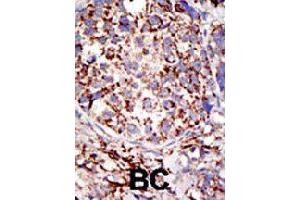 Formalin-fixed and paraffin-embedded human cancer tissue reacted with USP3 polyclonal antibody  , which was peroxidase-conjugated to the secondary antibody, followed by DAB staining. (USP3 Antikörper  (C-Term))