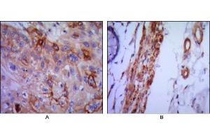 Immunohistochemical analysis of paraffin-embedded human lung cancer (A) and colon cancer (B) using VCAM1 mouse mAb with DAB staining.