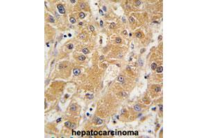 Formalin-fixed and paraffin-embedded human hepatocarcinomareacted with APOA5 polyclonal antibody , which was peroxidase-conjugated to the secondary antibody, followed by AEC staining. (APOA5 Antikörper  (N-Term))