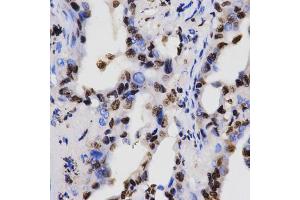 Immunohistochemistry of paraffin-embedded human lung cancer using Dimethyl-Histone H3-K4 antibody (ABIN5969803) at dilution of 1/200 (40x lens). (Histone 3 Antikörper  (H3K4me2))