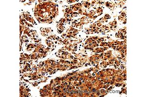 Immunohistochemistry of Human liver cancer using APLP1 Polyclonal Antibody at dilution of 1:25 (APLP1 Antikörper)