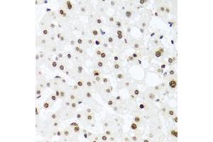 Immunohistochemistry of paraffin-embedded human liver injury using H2AFX antibody (ABIN4903860) at dilution of 1:100 (40x lens). (H2AFX Antikörper)
