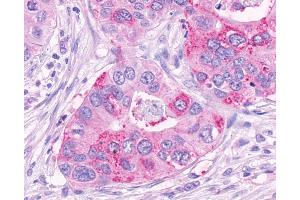 Anti-NPFF2 / NPFFR2 antibody IHC of human Pancreas, Carcinoma.