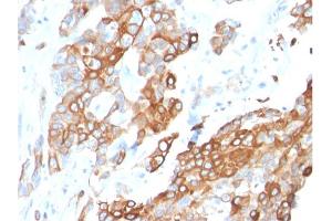 Formalin-fixed, paraffin-embedded human Breast Carcinoma stained with Heregulin-1 Mouse Monoclonal Antibody (NRG1/2710). (Neuregulin 1 Antikörper  (AA 21-242))