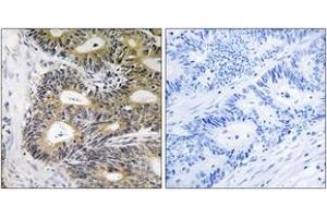 Immunohistochemistry analysis of paraffin-embedded human colon carcinoma, using TRAPPC6A Antibody. (TRAPPC6A Antikörper  (AA 31-80))