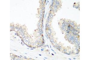 Immunohistochemistry of paraffin-embedded Human prostate using NEDD4 Polyclonal Antibody at dilution of 1:200 (40x lens). (NEDD4 Antikörper)