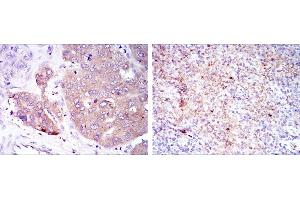 Immunohistochemical analysis of paraffin-embedded liver cancer (left) and submaxillary tumor (right) using EIF4E mouse mAb with DAB staining. (EIF4E Antikörper)